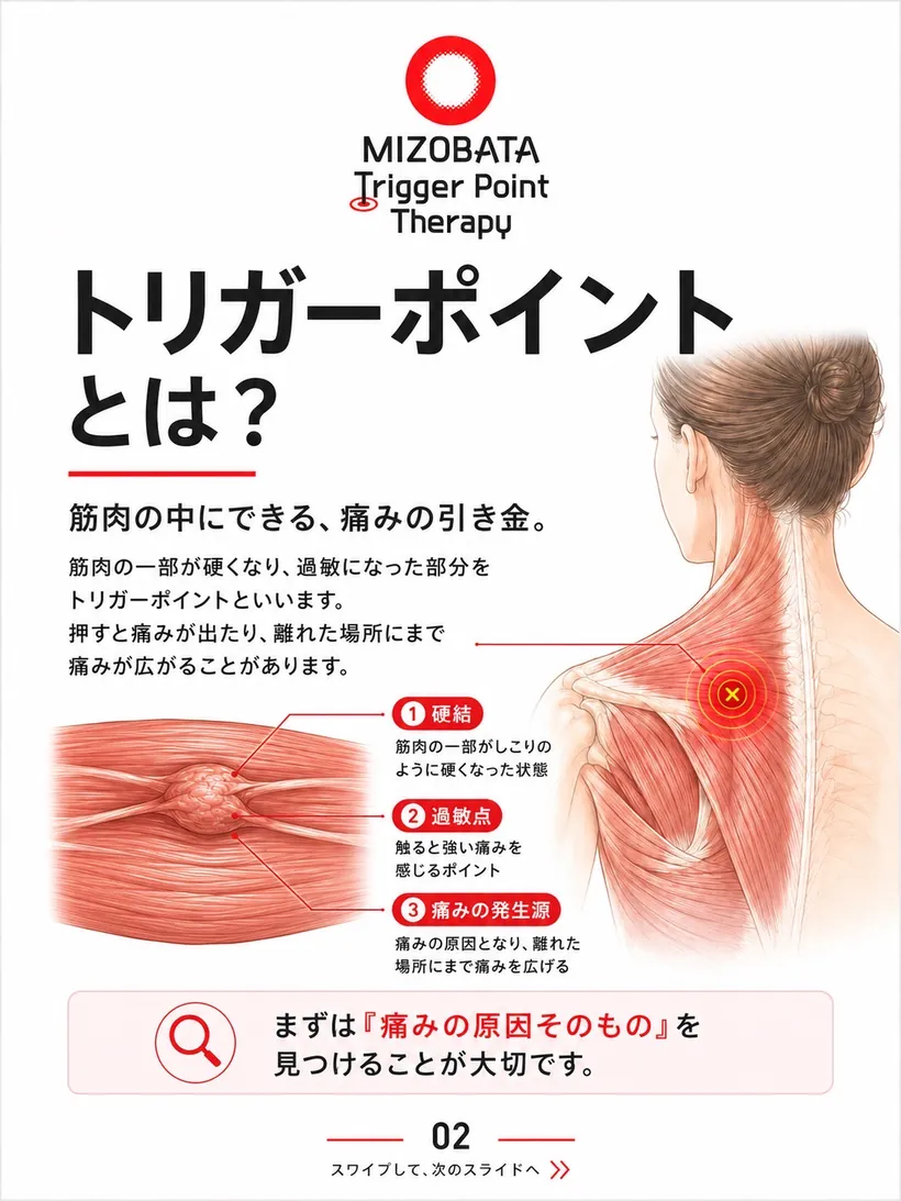 トリガーポイントとは？ — 筋肉の中にできる痛みの引き金